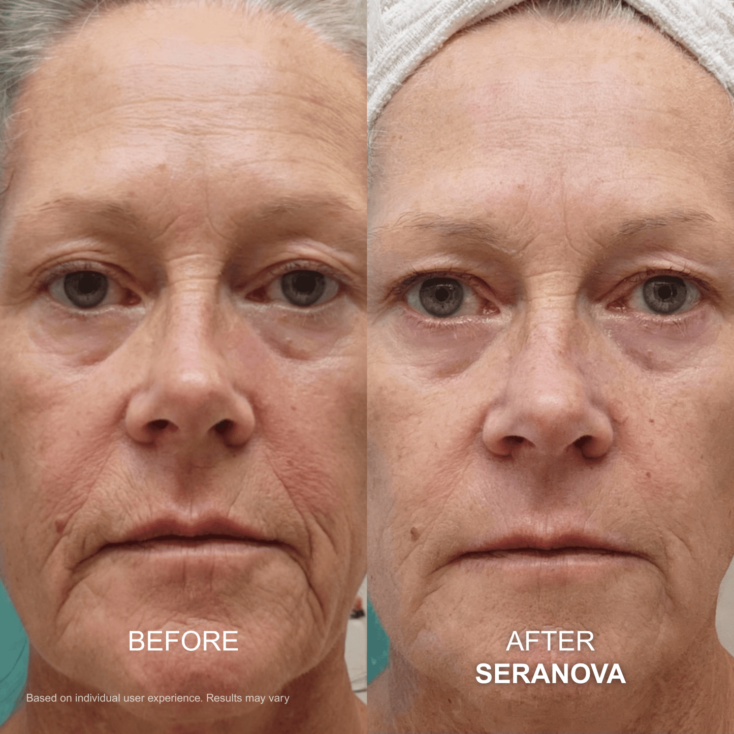 The Micro Infusion System™