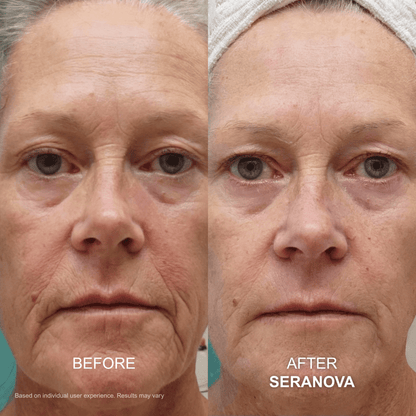 The Micro Infusion System™