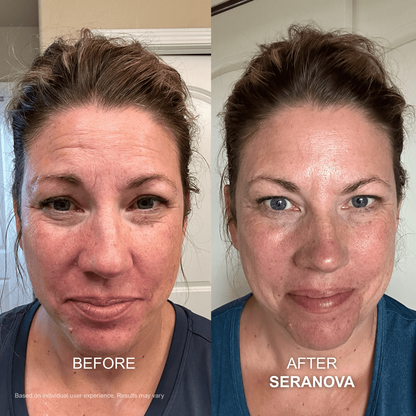 The Micro Infusion System™